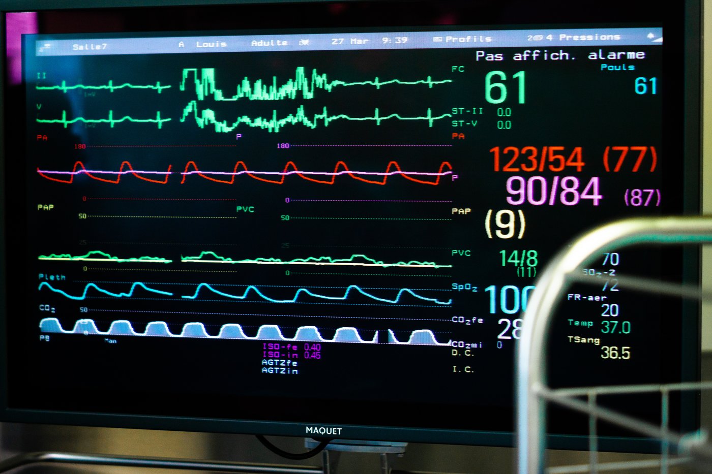 AI Algorithm Outperforms Human ECG Interpretation